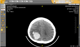 Brain CT Scan